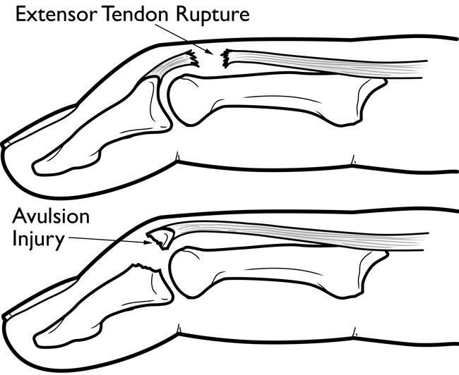 mallet-finger-tendon-rupture-injury-hand-therapy-2