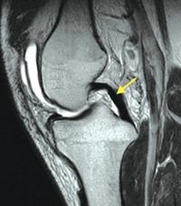 anterior-cruciate-ligament-tear-physiotherapy