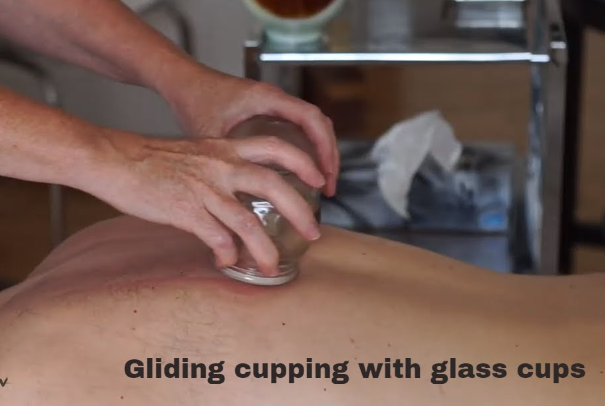 gliding-tcm-cupping-singapore