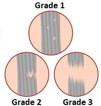 knee-ligament-sprain-different-sprain-grades