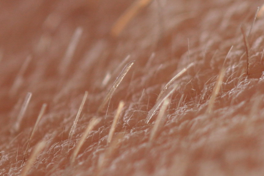 unnatural-excess-hair-on-scar